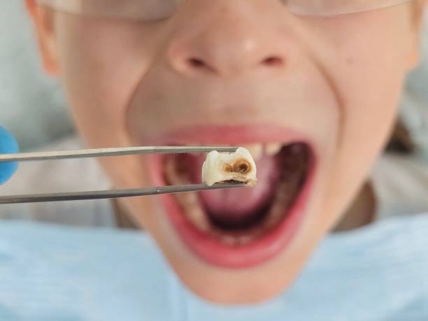 Best Emergency Treatment for Dental Infections or Abscesses in Strathmore, CA